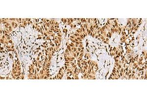 Immunohistochemistry of paraffin-embedded Human ovarian cancer tissue using PHF5A Polyclonal Antibody at dilution of 1:55(x200) (PHF5A anticorps)