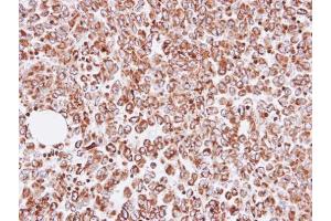 IHC-P Image Immunohistochemical analysis of paraffin-embedded human gastric cancer, using OAT, antibody at 1:100 dilution.