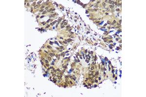 Immunohistochemistry of paraffin-embedded Human colon carcinoma using UB antibody (2359) at dilution of 1:100 (40x lens). (UBA1 anticorps  (AA 300-600))