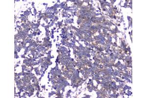 IHC testing of FFPE human lung cancer tissue with RAB27A antibody at 1ug/ml. (RAB27A anticorps)