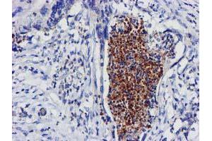 Immunohistochemical staining of paraffin-embedded Carcinoma of Human pancreas tissue using anti-EXOSC7 mouse monoclonal antibody.