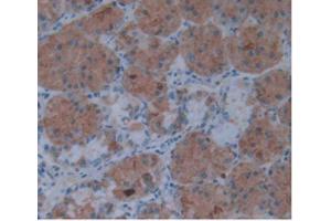IHC-P analysis of Human Stomach Cancer Tissue, with DAB staining. (IL1A anticorps  (AA 113-271))
