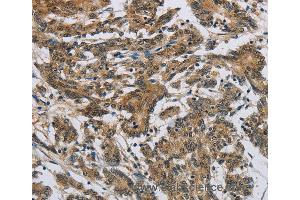 Immunohistochemistry of Human colon cancer using SYN1 Polyclonal Antibody at dilution of 1:50 (SYN1 anticorps)