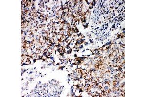 IHC-P: Prohibitin 2 antibody testing of human lung cancer tissue