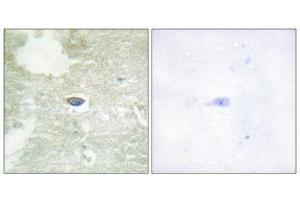Immunohistochemistry (IHC) image for anti-Transforming Growth Factor, beta Receptor II (70/80kDa) (TGFBR2) (pSer225), (pSer250) antibody (ABIN1847404) (TGFBR2 anticorps  (pSer225, pSer250))