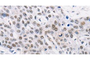 Immunohistochemistry of paraffin-embedded Human esophagus cancer using TRIM63 Polyclonal Antibody at dilution of 1:60 (TRIM63 anticorps)