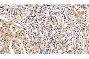 Detection of IL10Ra in Human Lung cancer Tissue using Polyclonal Antibody to Interleukin 10 Receptor Alpha (IL10Ra) (IL-10RA anticorps  (AA 132-235))