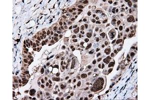Immunohistochemical staining of paraffin-embedded Adenocarcinoma of breast tissue using anti-KIAA1609 mouse monoclonal antibody. (KIAA1609 anticorps)