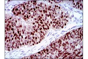 Immunohistochemical analysis of paraffin-embedded ovarian cancer tissues using PLAGL1 mouse mAb with DAB staining. (PLAGL1 anticorps  (AA 118-222))