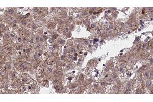 ABIN6273972 at 1/100 staining Human liver cancer tissue by IHC-P.