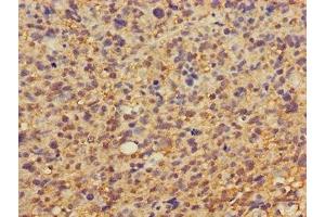 Immunohistochemistry of paraffin-embedded human glioma using ABIN7149878 at dilution of 1:100