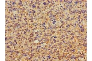 Immunohistochemistry of paraffin-embedded human glioma using ABIN7149878 at dilution of 1:100 (DKK1 anticorps  (AA 33-266))