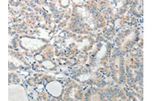 The image on the left is immunohistochemistry of paraffin-embedded Human thyroid cancer tissue using ABIN7189711(AGAP1 Antibody) at dilution 1/25, on the right is treated with synthetic peptide. (AGAP1 anticorps)