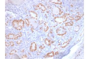 Formalin-fixed, paraffin-embedded human Lung Adenocarcinoma stained with TTF-1 Mouse Recombinant Monoclonal Antibody (rNX2. (Recombinant NKX2-1 anticorps)