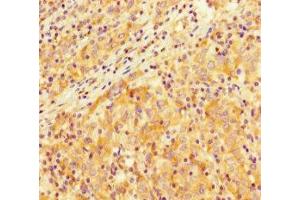 Immunohistochemistry of paraffin-embedded human lung cancer using ABIN7172403 at dilution of 1:100 (SMARCA4 anticorps  (AA 808-1092))