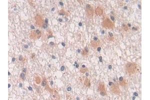 Detection of TGFb3 in Human Glioma Tissue using Polyclonal Antibody to Transforming Growth Factor Beta 3 (TGFb3) (TGFB3 anticorps  (AA 24-300))