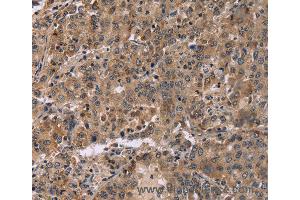Immunohistochemistry of Human colon cancer using FAM107A Polyclonal Antibody at dilution of 1:30 (FAM107A anticorps)