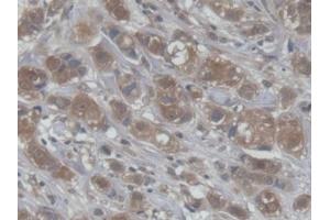 DAB staining on IHC-P; Samples: Human Breast cancer Tissue (CRABP1 anticorps  (AA 2-137))