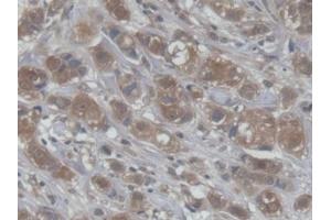 DAB staining on IHC-P; Samples: Human Breast cancer Tissue