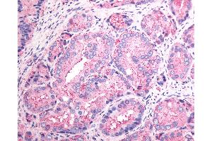 Anti-SSTR1 antibody IHC of human Prostate, Carcinoma.