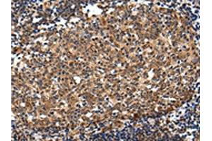 The image on the left is immunohistochemistry of paraffin-embedded Human colorectal cancer tissue using ABIN7193115(ZNF473 Antibody) at dilution 1/30, on the right is treated with synthetic peptide. (ZNF473 anticorps)