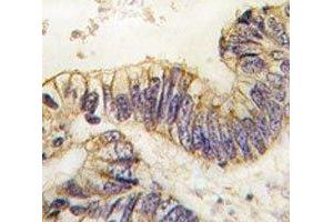 IHC analysis of FFPE human colon carcinoma tissue stained with SRC-1 antibody