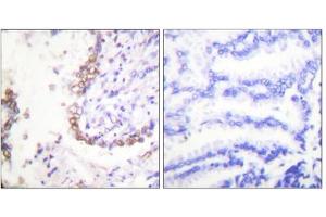 Immunohistochemical analysis of paraffin-embedded human lung carcinoma tissue, using OCT3 antibody (ABIN5976473). (OCT4 anticorps  (Internal Region))