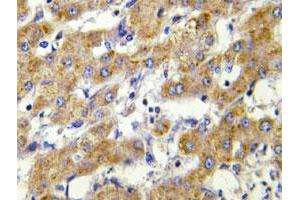 Immunohistochemical analysis of paraffin-embedded human liver carcinoma tissue using CYP2C8/CYP2C9/CYP2C18/CYP2C19 polyclonal antibody . (CYP2C8 anticorps)