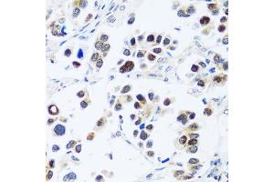 Immunohistochemistry of paraffin-embedded human lung cancer using BRIX1 antibody (ABIN7265951) at dilution of 1:100 (40x lens).