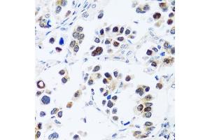 Immunohistochemistry of paraffin-embedded human lung cancer using BRIX1 antibody (ABIN7265951) at dilution of 1:100 (40x lens). (BRIX1 anticorps  (AA 1-353))