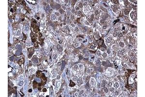 IHC-P Image MMP10 antibody detects MMP10 protein at secreted on human cervical carcinoma by immunohistochemical analysis.