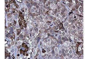 IHC-P Image MMP10 antibody detects MMP10 protein at secreted on human cervical carcinoma by immunohistochemical analysis. (MMP10 anticorps)