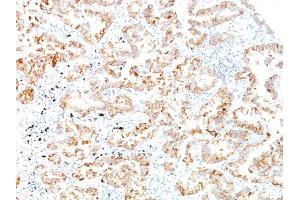 Formalin-fixed, paraffin-embedded human Lung SCC stained with Cytokeratin 7 Monoclonal Antibody (SPM270). (Cytokeratin 7 anticorps)