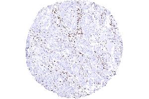 Ductal adenocarcinoma of the pancreas with complete loss of SMARCA4 staining in all tumor cells