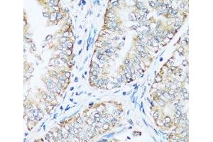 Immunohistochemistry of paraffin-embedded Human uterine cancer using ATP5I Polyclonal Antibody at dilution of 1:100 (40x lens).
