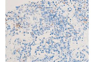 ABIN6267222 at 1/100 staining rat cancer tissue sections by IHC-P.