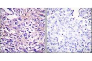 Immunohistochemistry analysis of paraffin-embedded human breast carcinoma, using MYPT1 (Phospho-Thr696) Antibody.