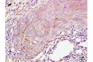 Formalin-fixed and paraffin embedded human lung carcinoma tissue labeled with Anti-S100A7 Polyclonal Antibody, Unconjugated (ABIN718301) at 1:200 followed by conjugation to the secondary antibody and DAB staining