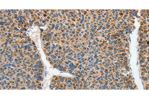 Immunohistochemistry of paraffin-embedded Human liver cancer using DSCR1 Polyclonal Antibody at dilution of 1:45 (RCAN1 anticorps)