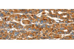 Immunohistochemistry of paraffin-embedded Human liver cancer using ERP44 Polyclonal Antibody at dilution of 1/20 (ERP44 anticorps)