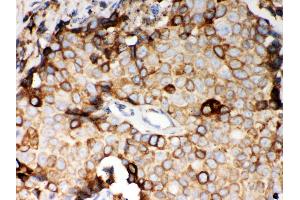 Anti- STIM1 Picoband antibody, IHC(P) IHC(P): Human Mammary Cancer Tissue (STIM1 anticorps  (N-Term))