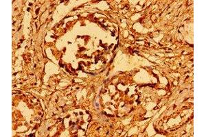 Immunohistochemistry of paraffin-embedded human breast cancer using  at dilution of 1:100 (GAB1 anticorps  (AA 119-329))