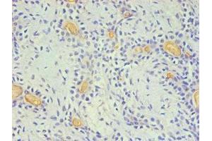 Immunohistochemical of paraffin-embedded Human breast cancer using ABIN7140934 (2E11-2B5) at dilution of 1:200.