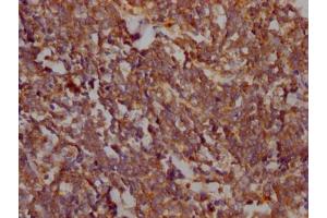 IHC image of ABIN7127482 diluted at 1:100 and staining in paraffin-embedded human lung cancer performed on a Leica BondTM system. (Recombinant FAK anticorps)