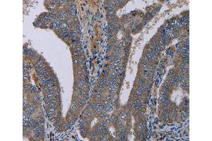 Immunohistochemistry of Human liver cancer using PVRL4 Polyclonal Antibody at dilution of 1:40 (PVRL4 anticorps)