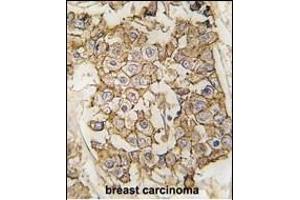 Formalin-fixed and paraffin-embedded human breast carcinoma tissue reacted with HER2/ErbB2 antibody (N-term) (ABIN391945 and ABIN2841744) , which was peroxidase-conjugated to the secondary antibody, followed by DAB staining.