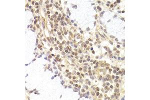 Immunohistochemistry of paraffin-embedded human adenomyosis using PHC1 antibody at dilution of 1:200 (400x lens). (PHC1 anticorps)