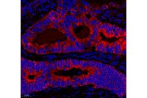 Immunofluorescence of paraffin embedded human colon cancer using NRP2 (ABIN7074826) at dilution of 1: 650 (400x lens)