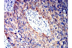 Immunohistochemical analysis of paraffin-embedded cervical cancer tissues using CTNNB1 mouse mAb with DAB staining.