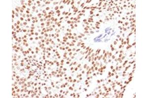 IHC testing of FFPE human bladder carcinoma with FOXA1 antibody. (FOXA1 anticorps  (AA 372-472))